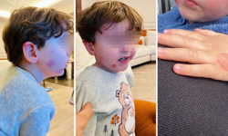 Sabah kreşe sağlam bırakıldı, akşam darbedilmiş bulundu