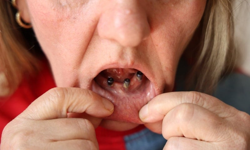 Diş ağrısıyla başladı, kabusa döndü; 25 dişinden oldu